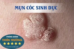Hình ảnh: Mụn cóc sinh dục.