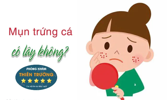 Hình ảnh: Mụn trứng cá có lây không