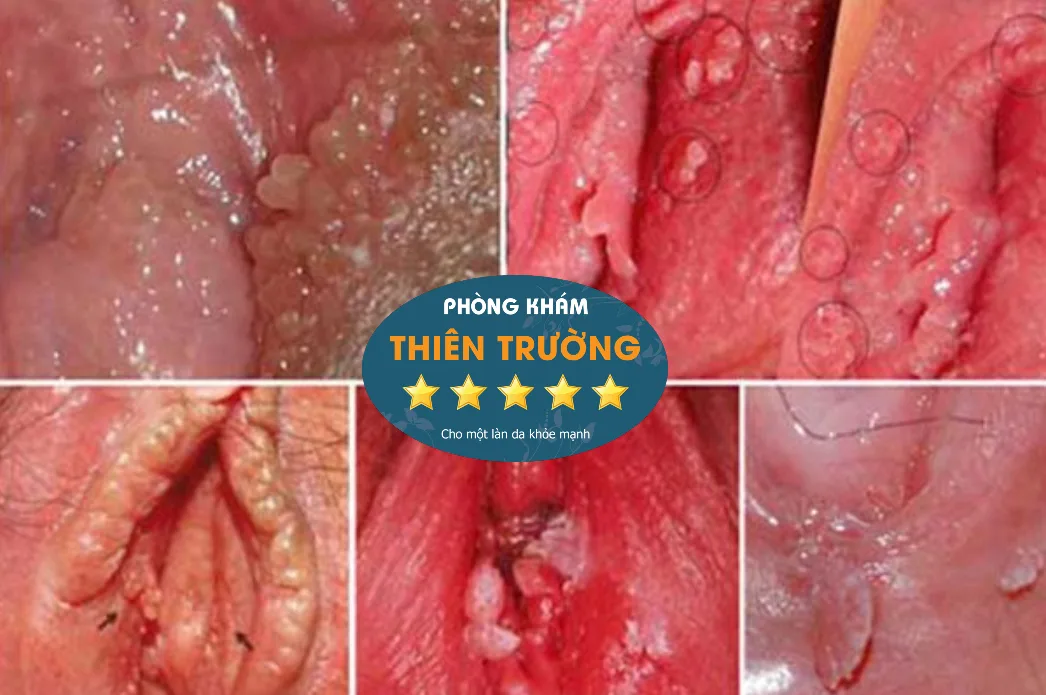 Hình ảnh: Mụn cóc sinh dục ở nữ giới