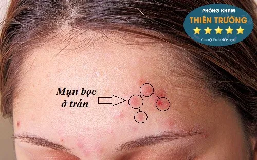 Hình ảnh: Mụn trên trán