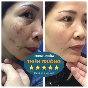 Hình ảnh: Trước và sau khi điều trị nám da tajki phòn gkhasm Da liexu Thẩm mỹ Thiên trường.