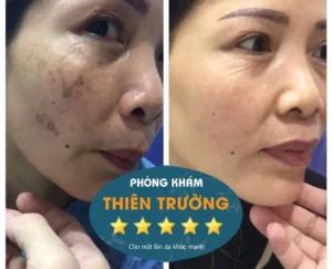 Hình ảnh: Trước và sau khi điều trị nám da tajki phòn gkhasm Da liexu Thẩm mỹ Thiên trường.