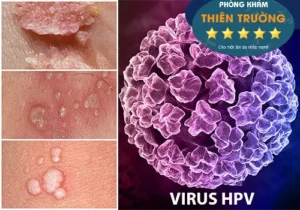 Hình ảnh: Nguyên nhân gây bệnh mụn cóc sinh dục và bệnh sùi mào gà