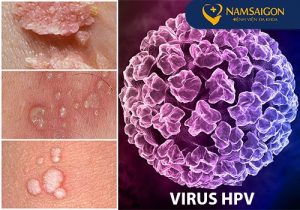 Hình ảnh: Nguyên nhân gây bệnh mụn cóc sinh dục và bệnh sùi mào gà