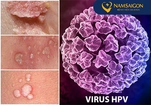 Hình ảnh: Nguyên nhân gây bệnh mụn cóc sinh dục và bệnh sùi mào gà