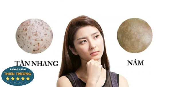 Hình ảnh: Nám và tàn nhang