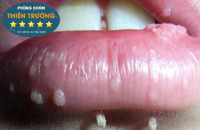 Hình ảnh: Mụn cóc sinh dục ở miệng.