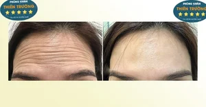 Hình ảnh: Trước và sau khi thực hiện xóa nhăn tại phòn gkhasm Da liễu-Thẩm mỹ Thiên trường.
