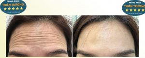 Hình ảnh: Trước và sau khi thực hiện xóa nhăn tại phòn gkhasm Da liễu-Thẩm mỹ Thiên trường.