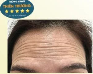 Hình ảnh: nếp nhăn vùng trán