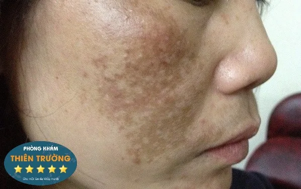 Hình ảnh: Nám mảng