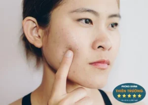 Hình ảnh: Nám da - nỗi lo lắng của phái đẹp
