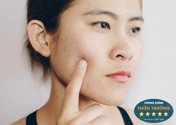 Hình ảnh: Nám da - nỗi lo lắng của phái đẹp