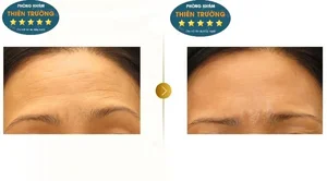 Hình ảnh: Trước và sau khi thực hiện xóa nhăn tại phòn gkhasm Da liễu-Thẩm mỹ Thiên trường.