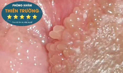 Hình ảnh: U nhú sinh dục.