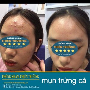 Hình ảnh: Khác hàng trước và sau khi điều trị mụn tại phòn gkhasm Da liễu-Thẩm mỹ Thiên Trường.