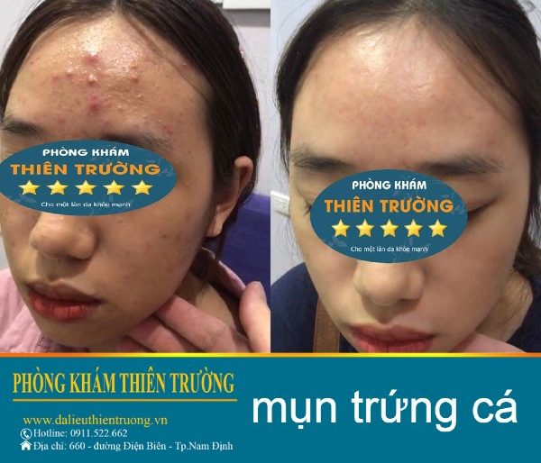 Hình ảnh: Khác hàng trước và sau khi điều trị mụn tại phòn gkhasm Da liễu-Thẩm mỹ Thiên Trường.