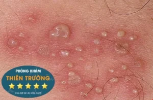 Hình ảnh: Mụn cóc sinh dục