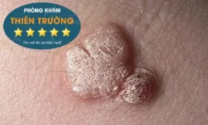Hình ảnh: Mụn cóc sinh dục