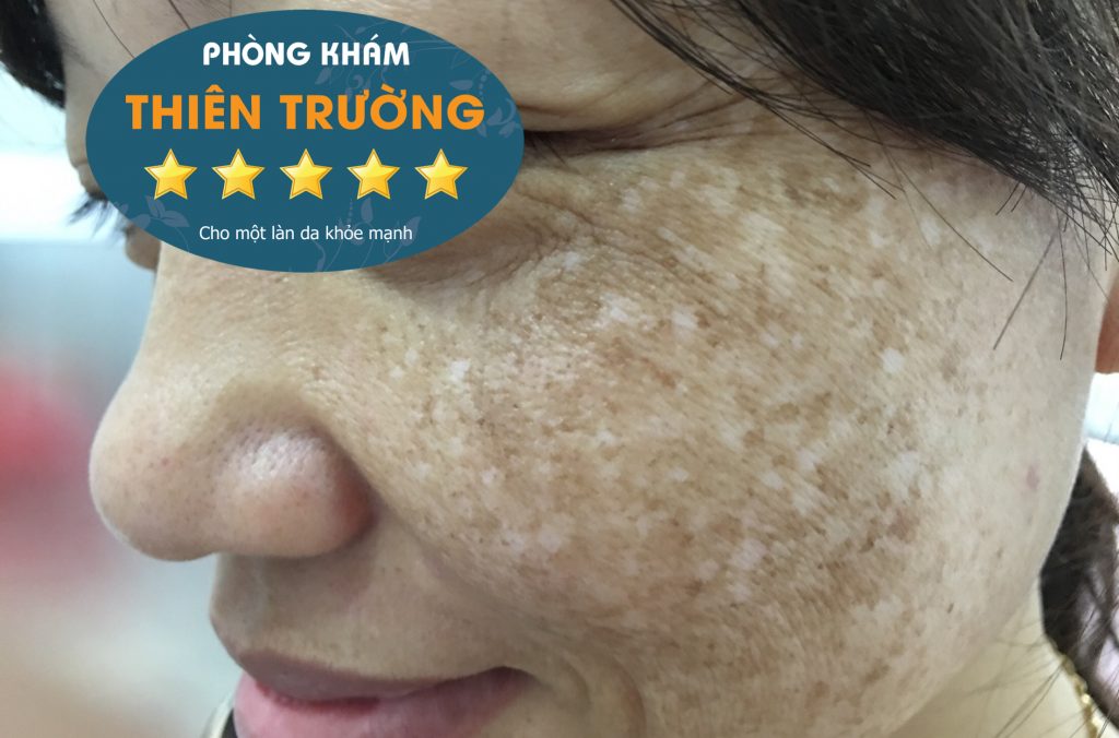 Hình ảnh: Nám da.