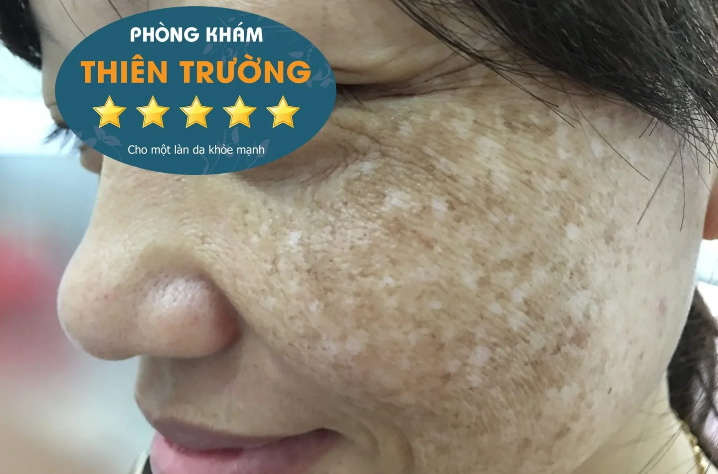 Hình ảnh: Nám da.