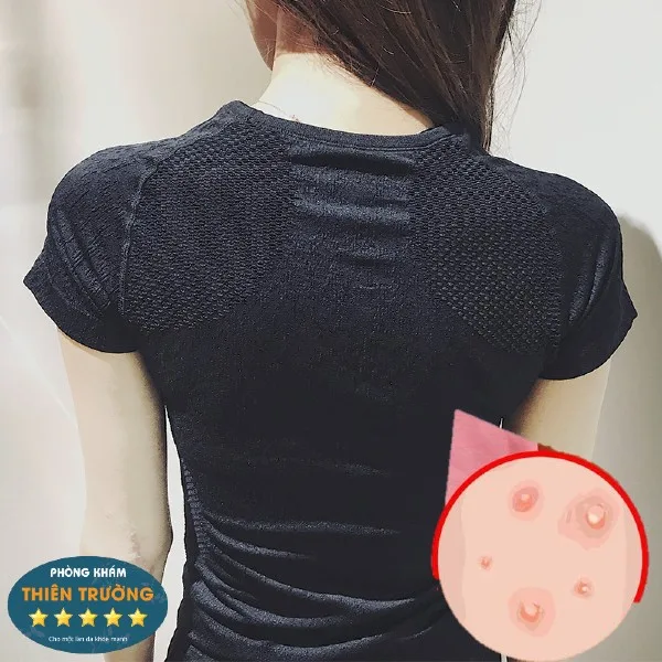 Hình ảnh: Không nên mặc áo quá chật