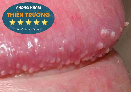 Hình ảnh: U nhú sinh dục ở nam giới.