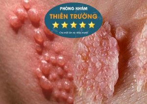 Hình ảnh : Sùi mào gà