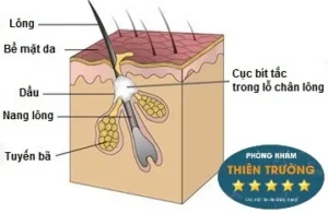 Hình ảnh: Lỗ chân lông bị bít tắc bởi bụi bẩn , tế bào chết , vi khuẩn.