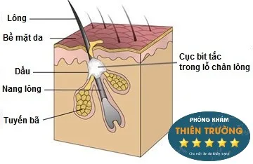 Hình ảnh: Lỗ chân lông bị bít tắc bởi bụi bẩn , tế bào chết , vi khuẩn.