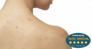 Hình ảnh : mụn trứng cá ở lưng.