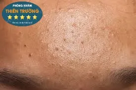 Hình ảnh: Mụn đầu đen ở trán.