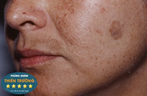 Hình ảnh: Nám hỗn hợp