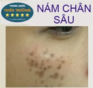 Hình ảnh: Nám chân sâu