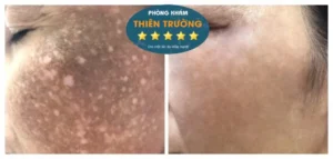 Hình ảnh: Trước và sau khi được hỗ trợ điều trị nám tại phòng khám Da liễu-Thẩm mỹ Thiên Trường