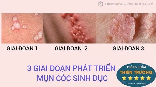 Hình ảnh: Mụn cóc sinh dục