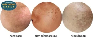 Hình ảnh: Phân biệt các loại nám