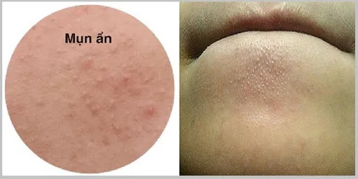 Hình ảnh: Mụn ẩn vùng cằm
