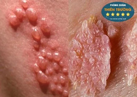 Hình ảnh: U nhú sinh dục và sùi mào gà.