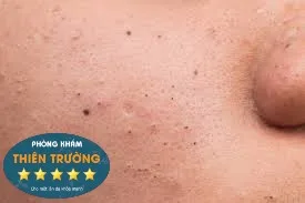 Hình ảnh: Mụn đầu đen.
