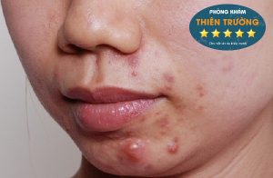 Hình ảnh: Mụn trứng cá bọc.