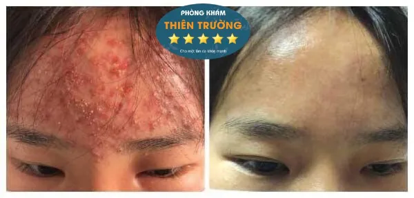 Hình ảnh: Trước và sau khi được điều trị mụn tại phòng khám.