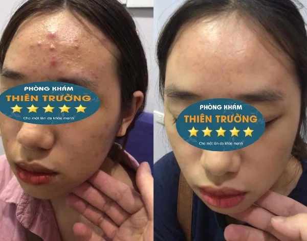 Hình ảnh: Trước và sau khi được điều trị mụn tai phòng khám.