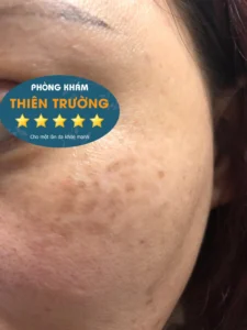 Hình ảnh: Nám da.