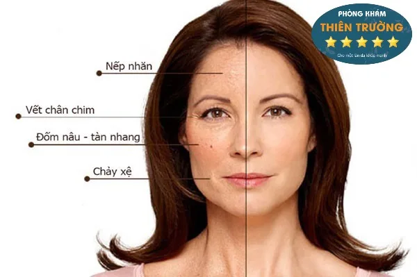 Hình ảnh: nếp nhăn vùng mắt.