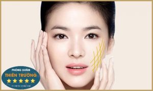 Hình ảnh : căng da mặt