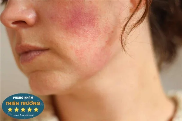 Hình ảnh: Dấu hiweeju dị ứng sau khi sử dụng kem chống nắng.