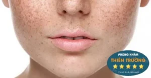 Hình ảnh: Nám và tàn nhang