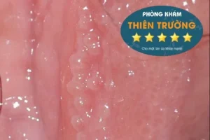 Hình ảnh: U nhú sinh dục.