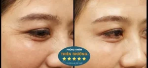 Hình ảnh: Trước và sau khi xóa nhăn vùng mắt